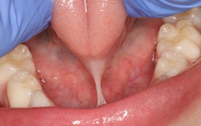 How to Check for a Tongue Tie in Children