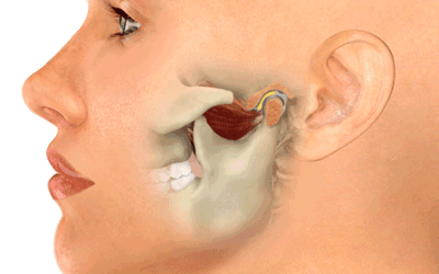 What is Temporomandibular Disorder (TMD)?