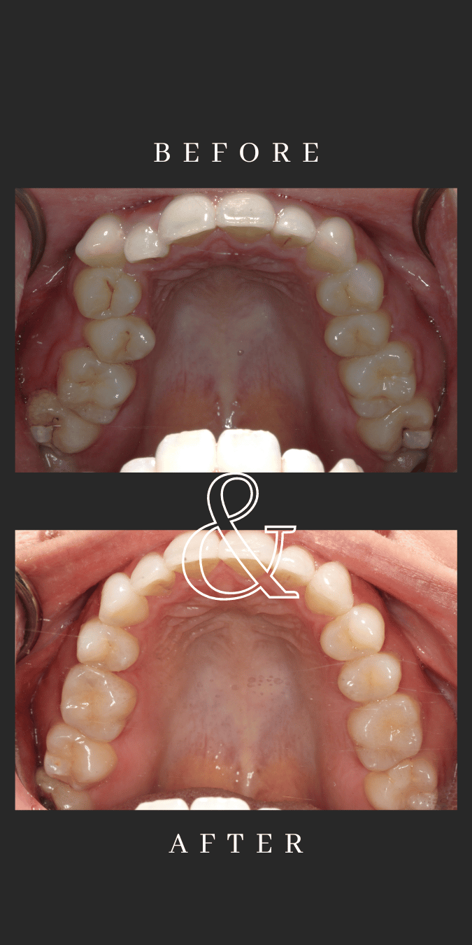 Before and after comparison of teeth alignment using Invisalign.