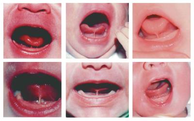 Tongue Ties in Children: Signs, Diagnosis, and Treatment Options