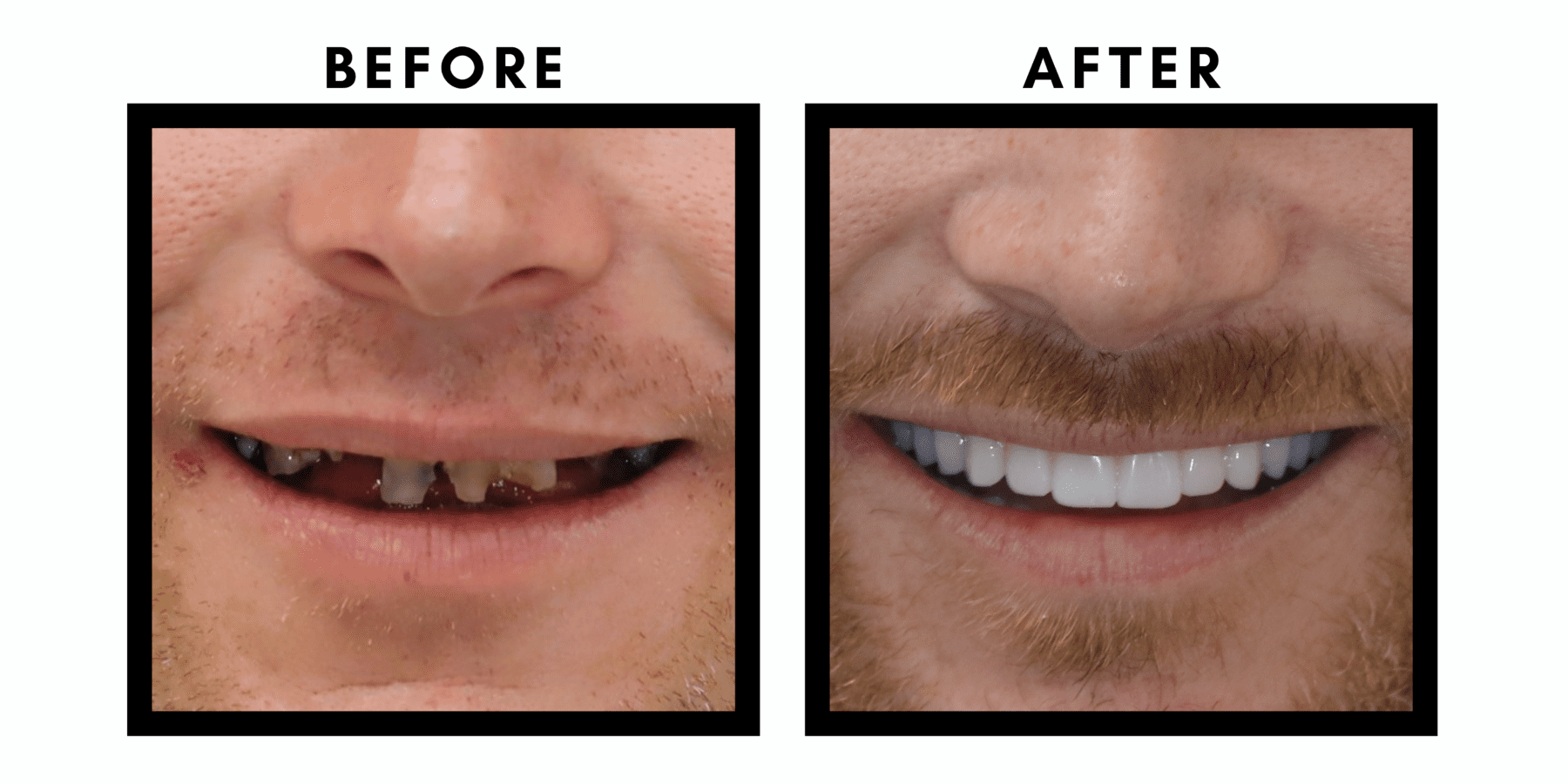 A side-by-side comparison of a patient's teeth before and after a professional dental treatment, showcasing a brighter, healthier smile.