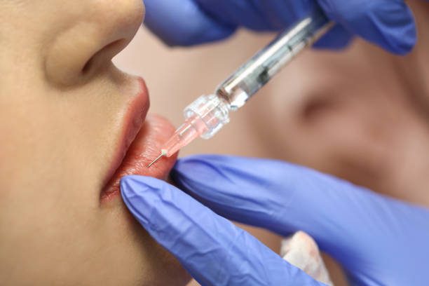 Dermal Filler