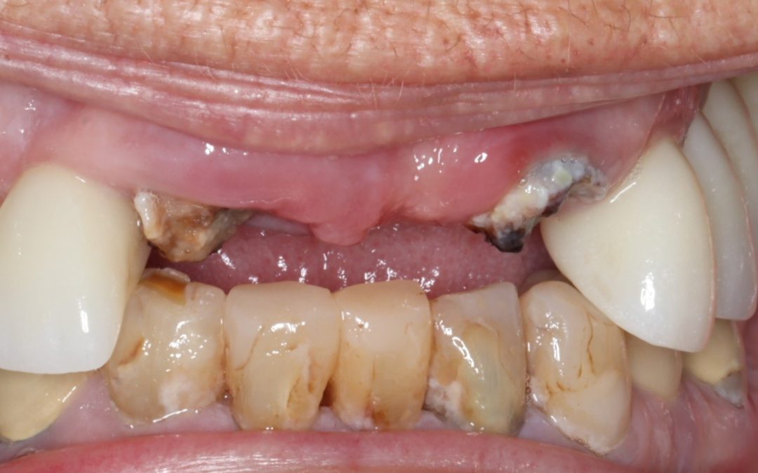 Is Root Canal Treatment Painful? Procedure, Recovery & Expert Tips