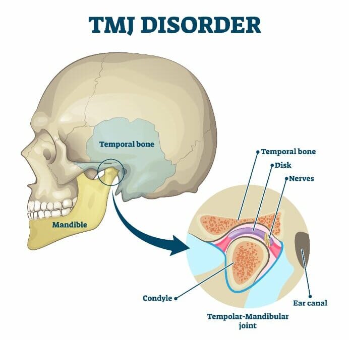 Temporomandibular Disorder (TMD): Symptoms and Causes