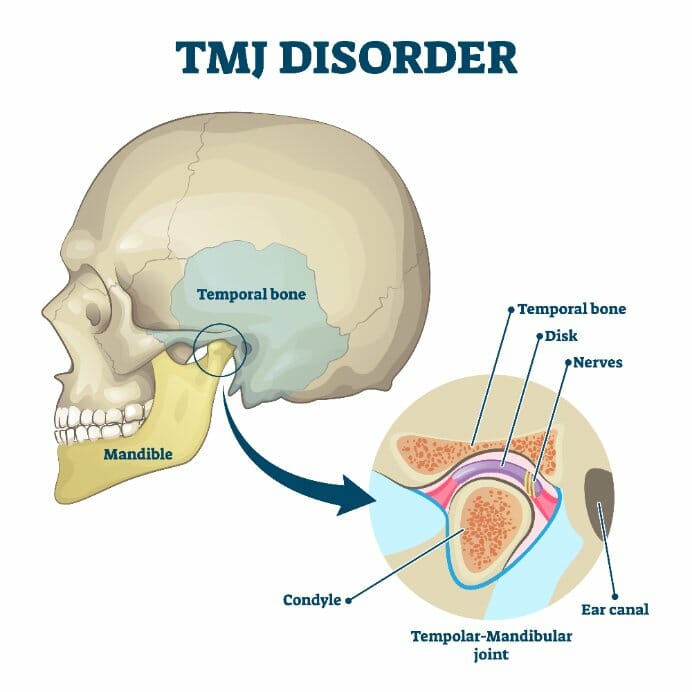 Diagramatical representation of what is tmj Diagramatical representation of what is tmj