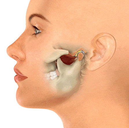 TMJ-Jaw-Locking (1) TMJ-Jaw-Locking