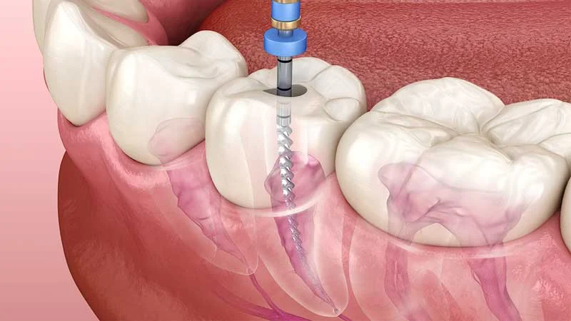 root-canal-procedure oot-canal-procedure